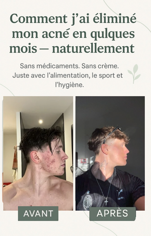 Comment j’ai vaincu mon acné en quelques mois – naturellement, sans produits inutile